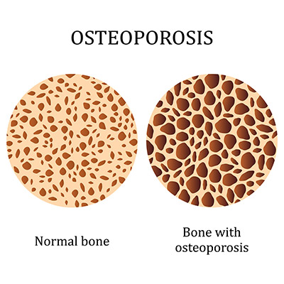 L’ostéoporose post-ménopausique